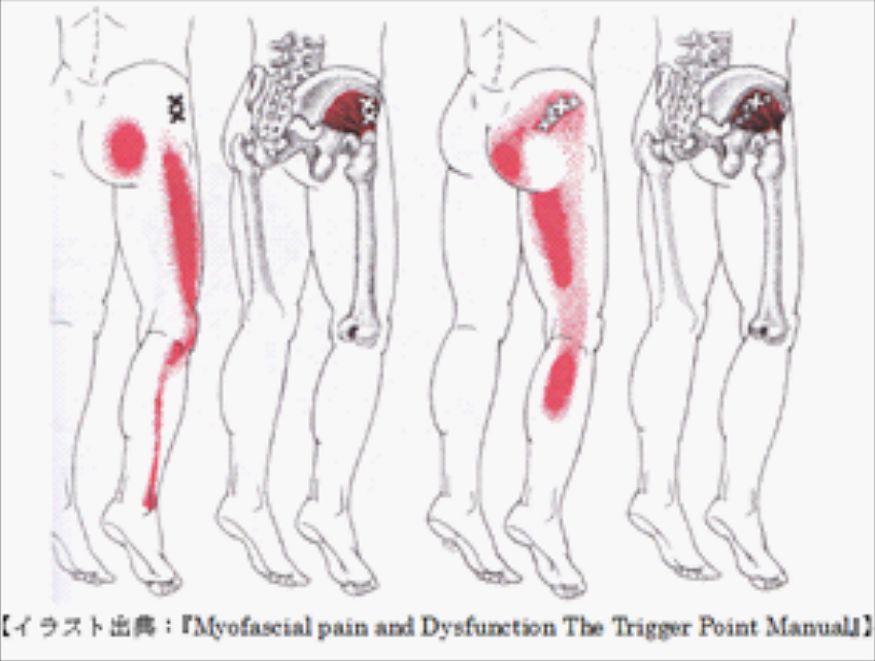 あなたの腰痛はどのタイプ トリガーポイントが作り出す腰痛の基本9タイプ 草加市 越谷市で整体をお探しの方 腰痛 肩こり等の痛み しびれを改善 トリガーポイント セラピーのひじりボディケアー