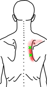菱形筋が起こす痛み・しびれ