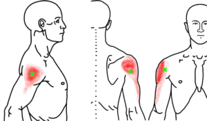 三角筋が起こす痛み・しびれ
