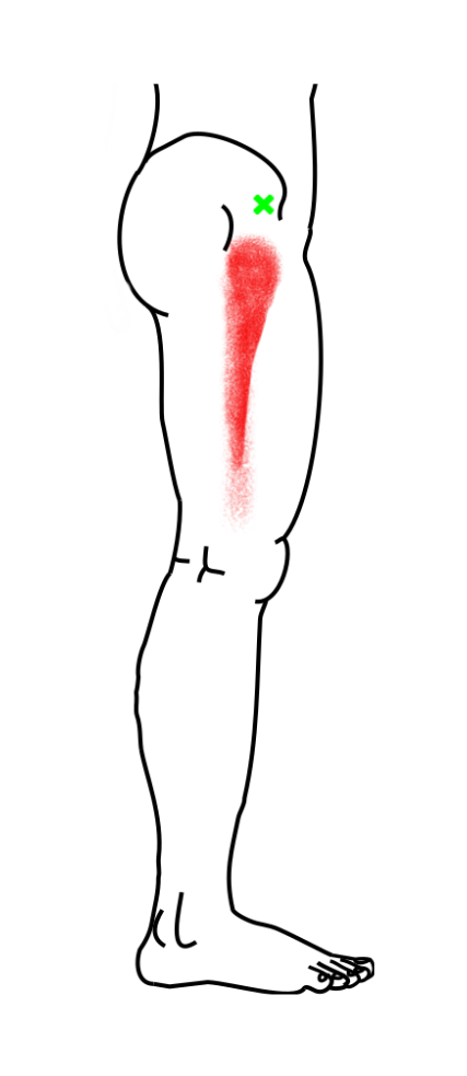 大腿筋膜張筋が起こす痛み・しびれ